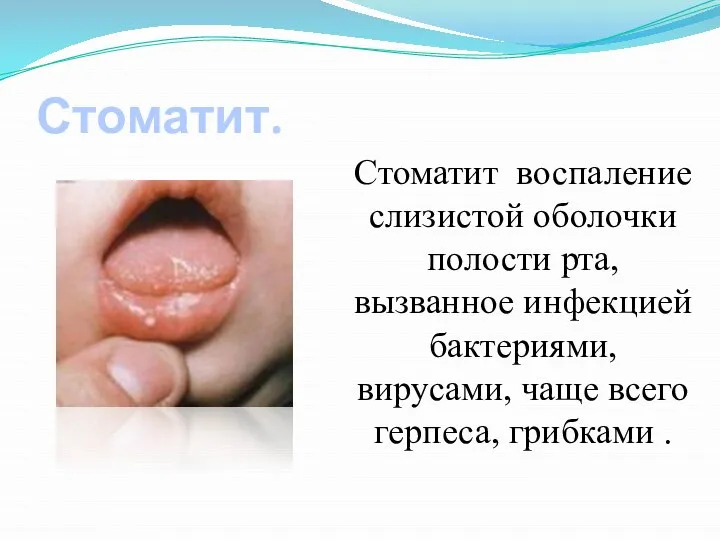 Стоматит. Стоматит воспаление слизистой оболочки полости рта, вызванное инфекцией бактериями, вирусами, чаще всего герпеса, грибками .