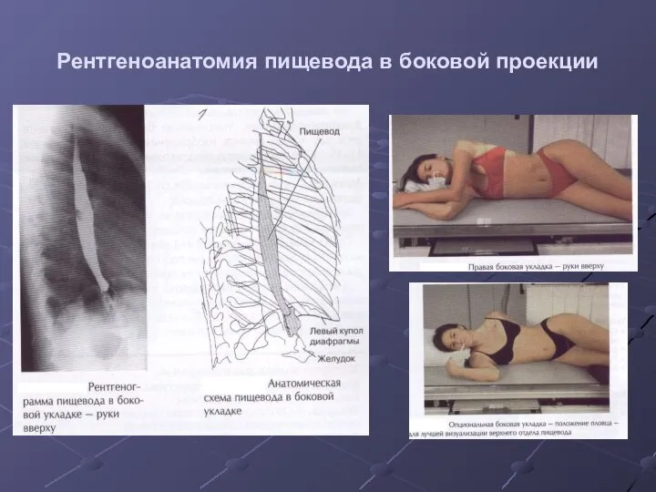 Рентгеноанатомия пищевода в боковой проекции