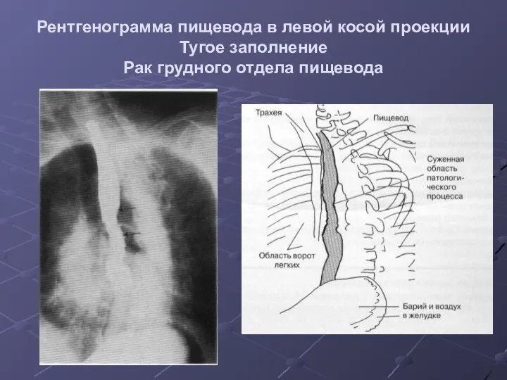 Рентгенограмма пищевода в левой косой проекции Тугое заполнение Рак грудного отдела пищевода