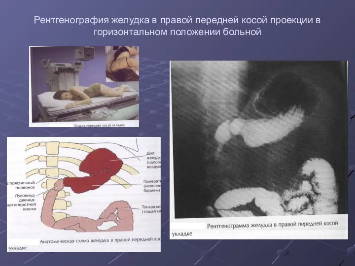 Рентгенография желудка в правой передней косой проекции в горизонтальном положении больной