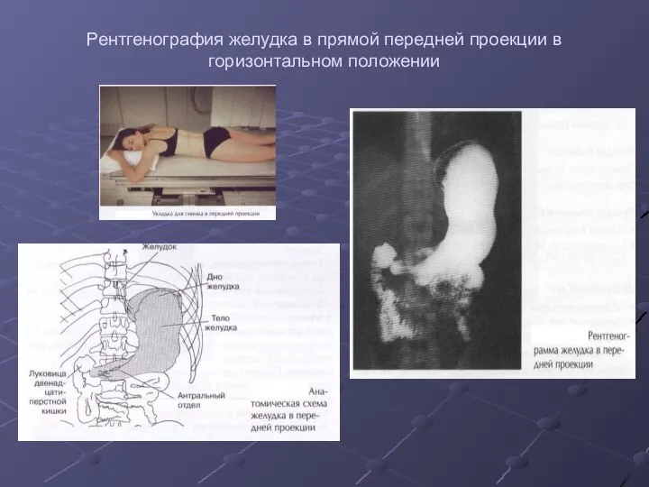 Рентгенография желудка в прямой передней проекции в горизонтальном положении