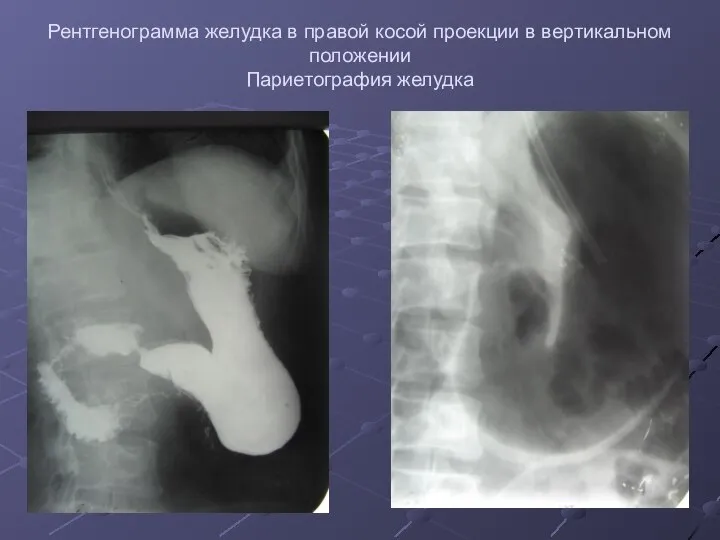 Рентгенограмма желудка в правой косой проекции в вертикальном положении Париетография желудка