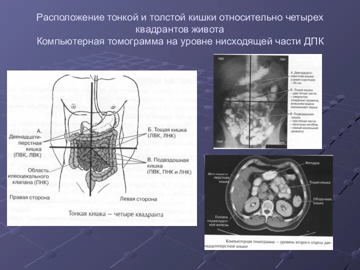 Расположение тонкой и толстой кишки относительно четырех квадрантов живота Компьютерная томограмма на уровне нисходящей части ДПК