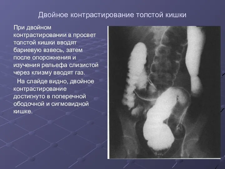 Двойное контрастирование толстой кишки При двойном контрастировании в просвет толстой кишки