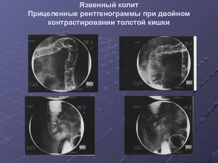 Язвенный колит Прицеленные рентгенограммы при двойном контрастировании толстой кишки