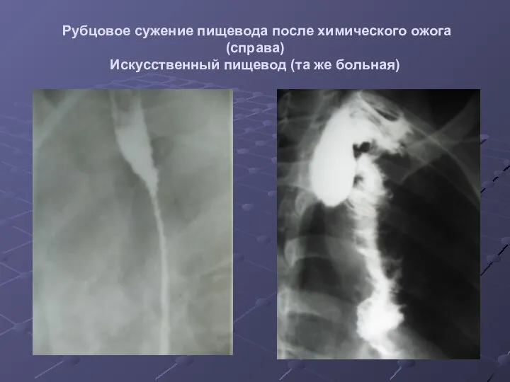 Рубцовое сужение пищевода после химического ожога (справа) Искусственный пищевод (та же больная)