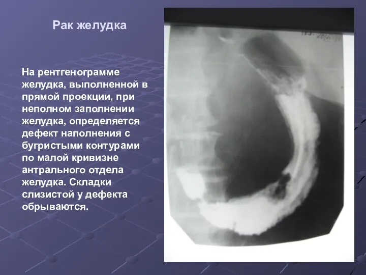 Рак желудка На рентгенограмме желудка, выполненной в прямой проекции, при неполном