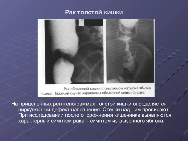 Рак толстой кишки На прицеленных рентгенограммах толстой кишки определяется циркулярный дефект