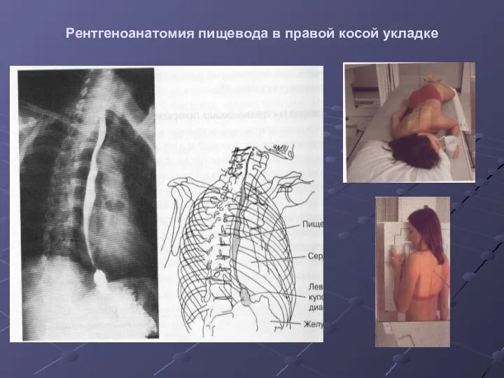 Рентгеноанатомия пищевода в правой косой укладке