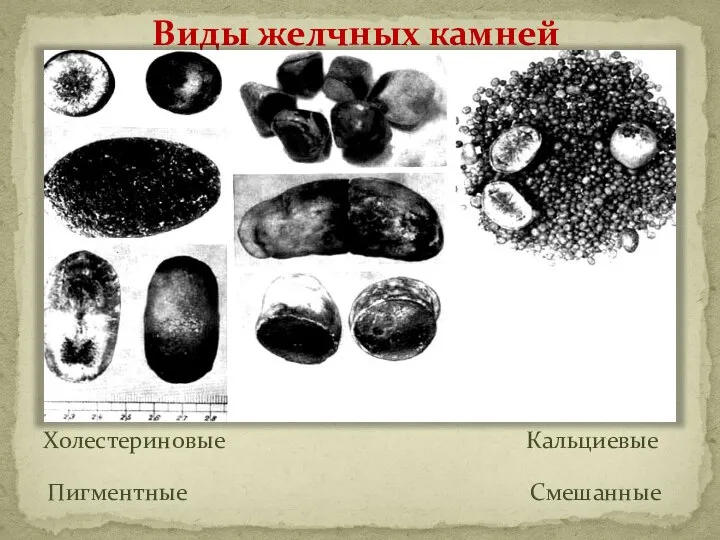 Виды желчных камней Холестериновые Кальциевые Пигментные Смешанные