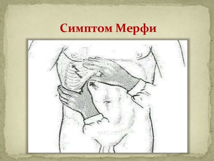 Симптом Мерфи