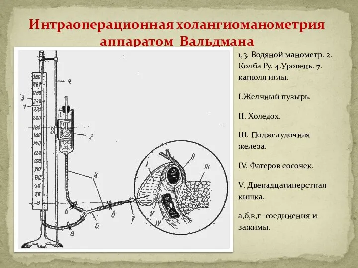 Интраоперационная холангиоманометрия аппаратом Вальдмана 1,3. Водяной манометр. 2. Колба Ру. 4.Уровень.