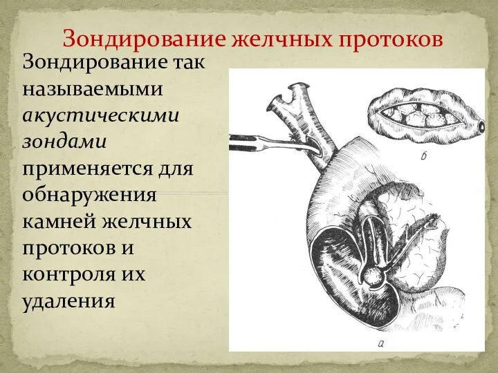 Зондирование желчных протоков Зондирование так называемыми акустическими зондами применяется для обнаружения