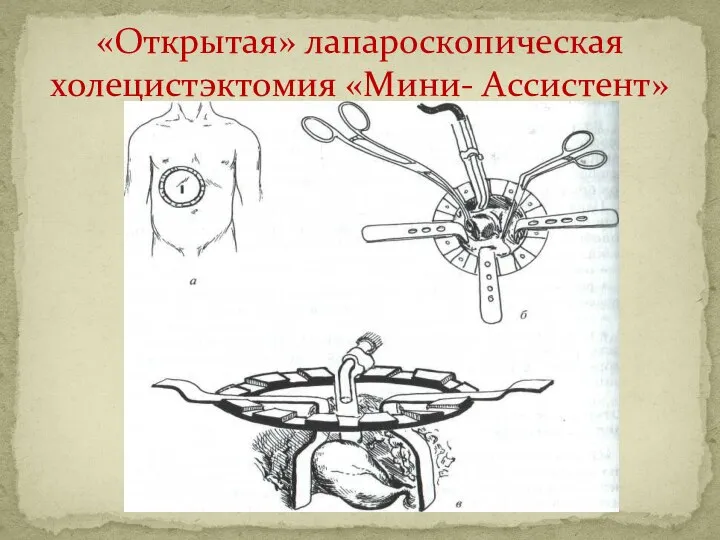 «Открытая» лапароскопическая холецистэктомия «Мини- Ассистент»