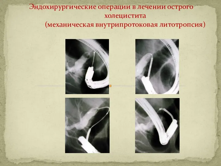 Эндохирургические операции в лечении острого холецистита (механическая внутрипротоковая литотропсия)