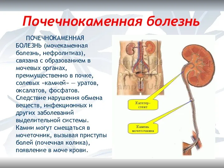 Почечнокаменная болезнь ПОЧЕЧНОКАМЕННАЯ БОЛЕЗНЬ (мочекаменная болезнь, нефролитиаз), связана с образованием в