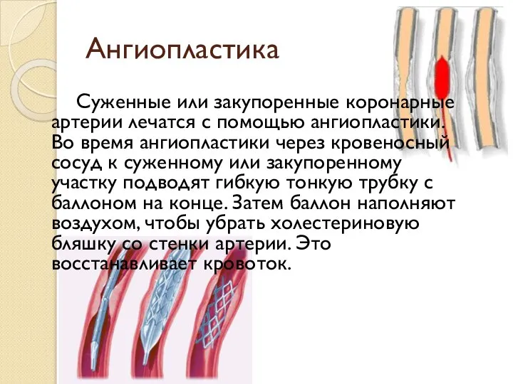 Ангиопластика Суженные или закупоренные коронарные артерии лечатся с помощью ангиопластики. Во