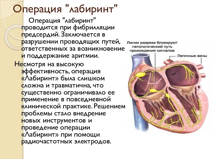 Операция "лабиринт" Операция "лабиринт" проводится при фибрилляции предсердий. Заключается в разрушении