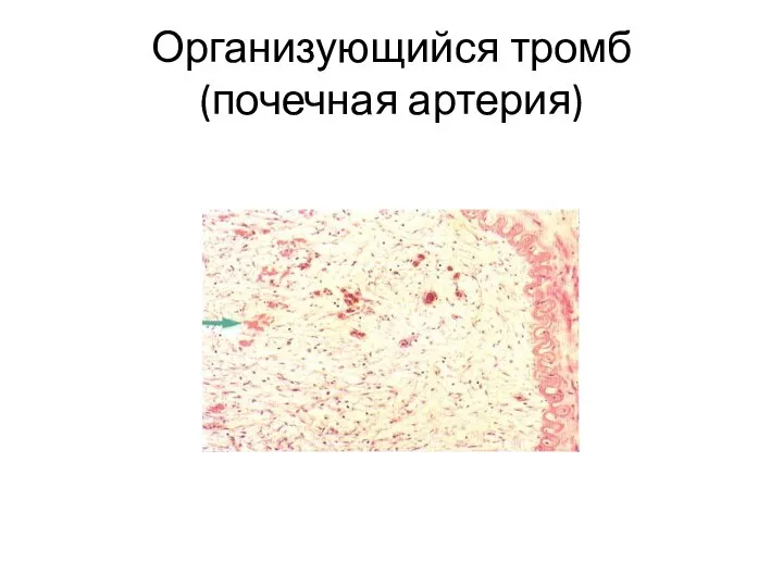 Организующийся тромб (почечная артерия)