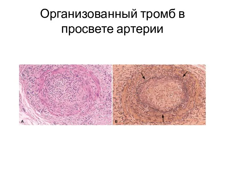 Организованный тромб в просвете артерии