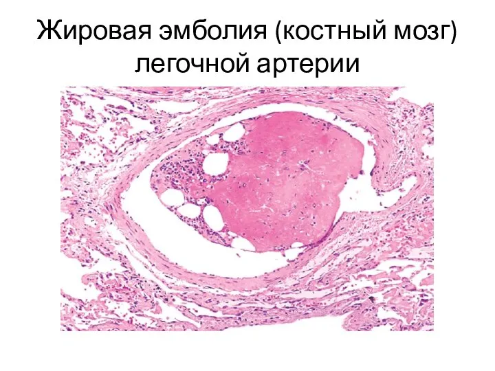 Жировая эмболия (костный мозг) легочной артерии