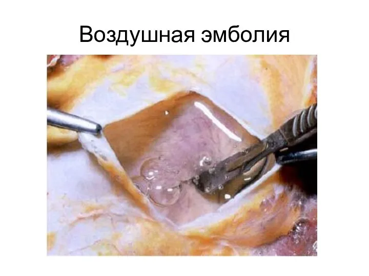 Воздушная эмболия