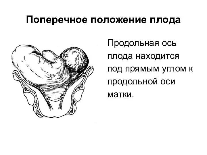 Поперечное положение плода Продольная ось плода находится под прямым углом к продольной оси матки.