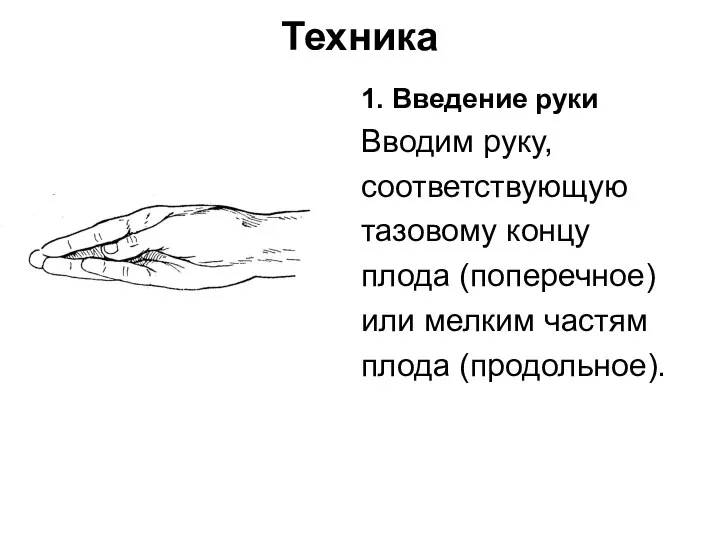 Техника 1. Введение руки Вводим руку, соответствующую тазовому концу плода (поперечное) или мелким частям плода (продольное).