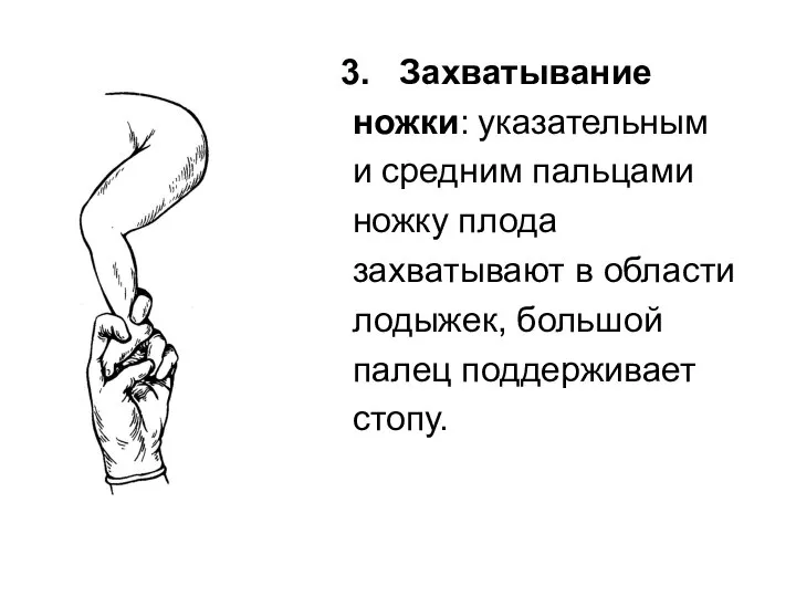 Захватывание ножки: указательным и средним пальцами ножку плода захватывают в области лодыжек, большой палец поддерживает стопу.