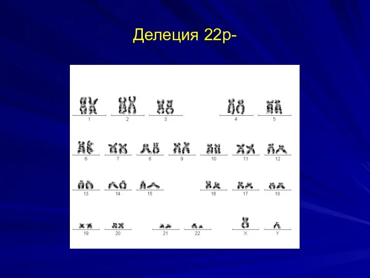 Делеция 22р-