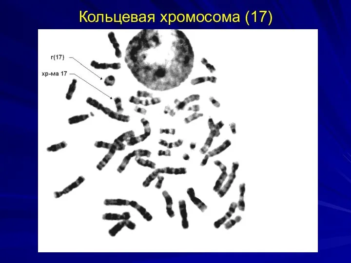 Кольцевая хромосома (17)