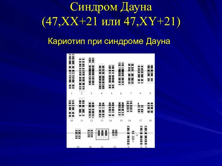 Синдром Дауна (47,XX+21 или 47,XY+21) Кариотип при синдроме Дауна