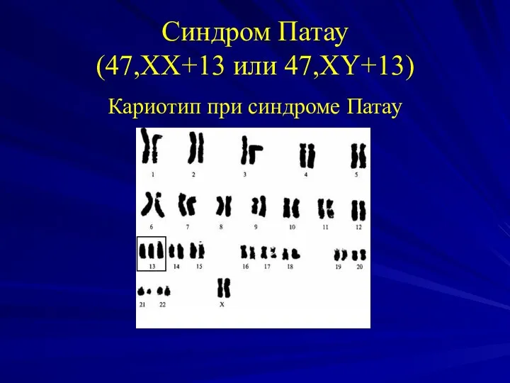 Синдром Патау (47,XX+13 или 47,XY+13) Кариотип при синдроме Патау
