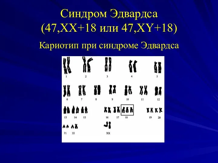 Синдром Эдвардса (47,XX+18 или 47,XY+18) Кариотип при синдроме Эдвардса