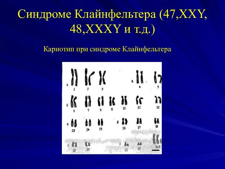 Синдроме Клайнфельтера (47,XXY, 48,XXXY и т.д.) Кариотип при синдроме Клайнфельтера