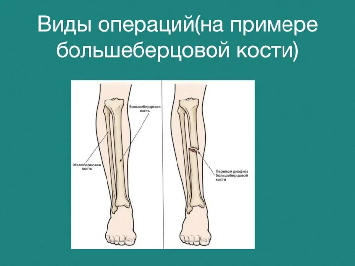 Виды операций(на примере большеберцовой кости)