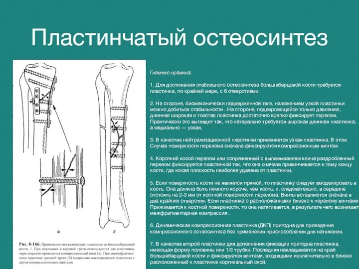 Пластинчатый остеосинтез Главные правила: 1. Для достижения стабильного остеосинтеза большеберцовой кости