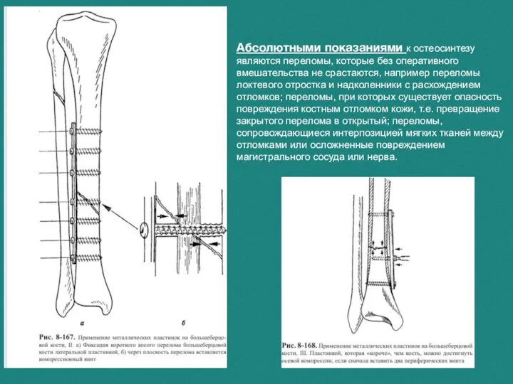 Абсолютными показаниями к остеосинтезу являются переломы, которые без оперативного вмешательства не