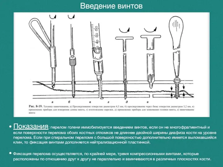 Введение винтов Показания: перелом голени иммобилизуется введением винтов, если он не