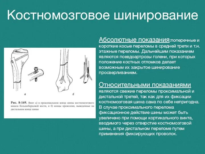 Костномозговое шинирование Абсолютные показания:поперечные и короткие косые переломы в средней трети