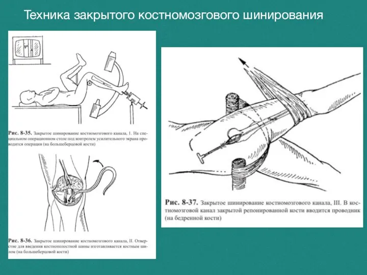 Техника закрытого костномозгового шинирования