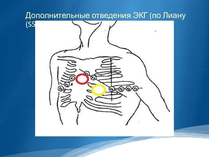 Дополнительные отведения ЭКГ (по Лиану (S5))