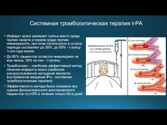 Инфаркт мозга занимает третье место среди причин смерти и первое среди