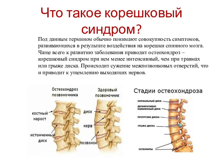 Что такое корешковый синдром? Под данным термином обычно понимают совокупность симптомов,