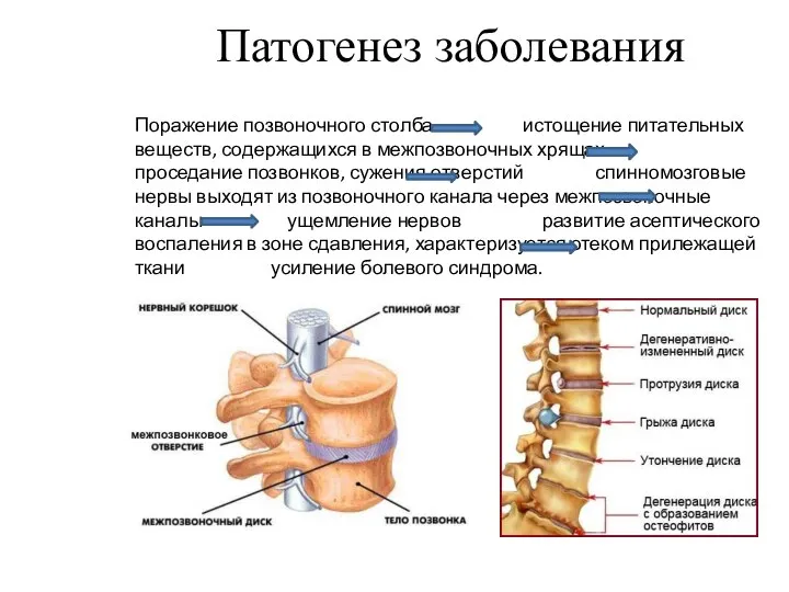 Патогенез заболевания Поражение позвоночного столба истощение питательных веществ, содержащихся в межпозвоночных