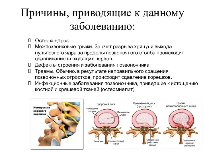 Причины, приводящие к данному заболеванию: Остеохондроз. Межпозвонковые грыжи. За счет разрыва