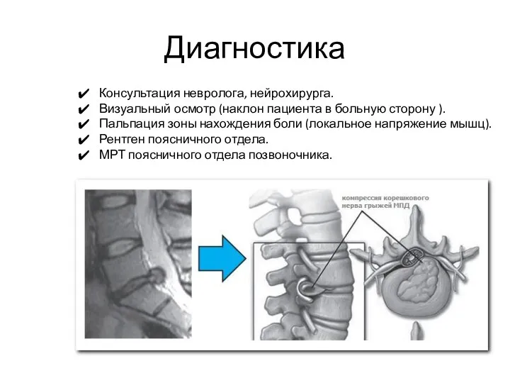 Диагностика Консультация невролога, нейрохирурга. Визуальный осмотр (наклон пациента в больную сторону