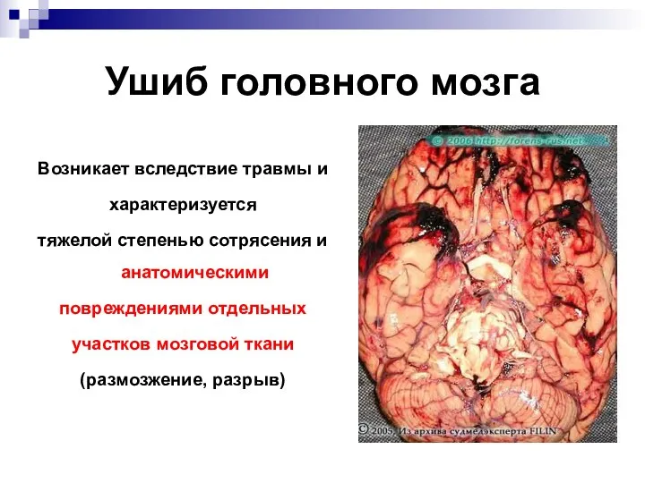 Ушиб головного мозга Возникает вследствие травмы и характеризуется тяжелой степенью сотрясения