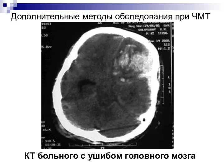 Дополнительные методы обследования при ЧМТ КТ больного с ушибом головного мозга