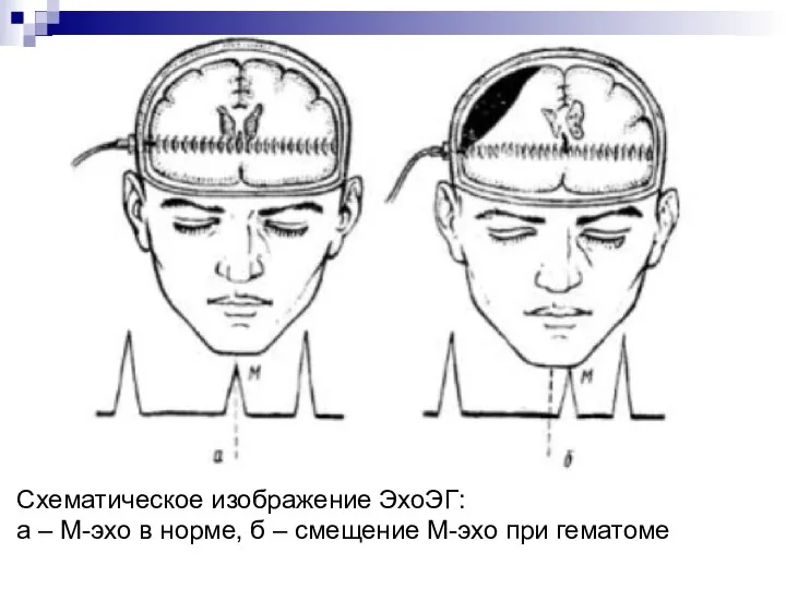 Схематическое изображение ЭхоЭГ: а – М-эхо в норме, б – смещение М-эхо при гематоме